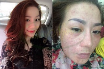 Cách trị mụn đầu đen, mụn cám trên mũi, thâm nám nặng - MSKH: TN15066